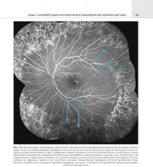 Флюоресцентная ангиография заднего полюса и периферии сетчатки - Фото 7