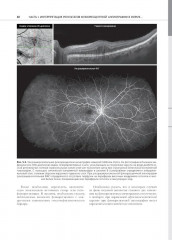 Флюоресцентная ангиография заднего полюса и периферии сетчатки - Фото 8