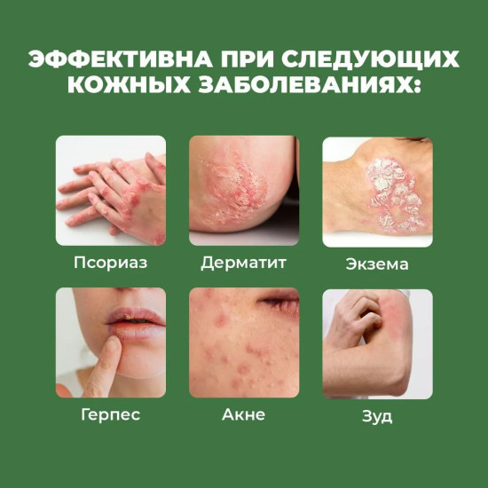 Крем для лечения заболеваний кожи «Eczema»