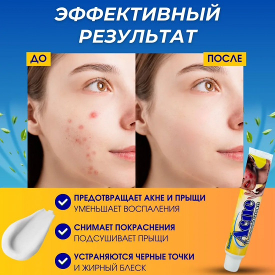 Крем лечебный для проблемной кожи лица «Acne removal cream»