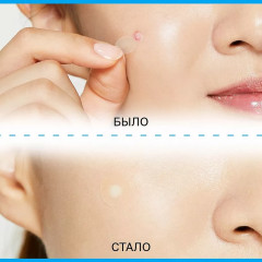 Набор патчей от прыщей с салициловой кислотой дневные «Anti-Acne Patch Deeply Cleanses Skin Day» - Фото 4