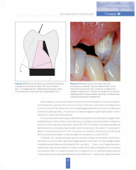 Вертикальное препарирование зубов под несъемные ортопедические конструкции - Фото 5