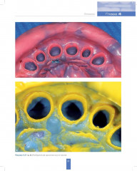 Вертикальное препарирование зубов под несъемные ортопедические конструкции - Фото 7