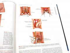 Клиническая онкогинекология. В 3 томах. Комплект из 3 книг - Фото 8