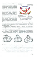 Пороки сердца: порок аортального клапана - Фото 11