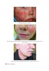 Дерматозы лица. Иллюстрированное руководство для врачей - Фото 8