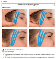 Нейромышечное тейпирование. Лечение отеков, гематом и рубцов - Фото 16