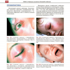 Атлас детских инфекционных заболеваний - Фото 9