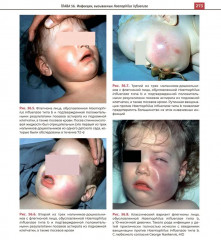 Атлас детских инфекционных заболеваний - Фото 10