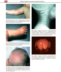 Атлас детских инфекционных заболеваний - Фото 11