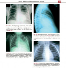 Атлас детских инфекционных заболеваний - Фото 12