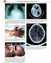 Атлас детских инфекционных заболеваний - Фото 13