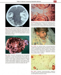 Атлас детских инфекционных заболеваний - Фото 14