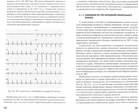Электрокардиограмма спортсмена