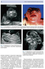 Ультразвуковая диагностика врожденных пороков развития плода - Фото 3