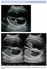 Ультразвуковая диагностика врожденных пороков развития плода - Фото 5