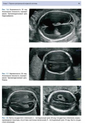 Ультразвуковая диагностика врожденных пороков развития плода - Фото 6