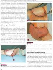 Сосудистые осложнения в реконструктивной микрохирургии - Фото 11