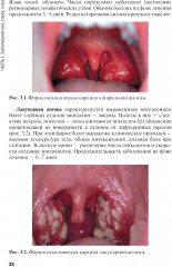 Сестринская помощь при заболеваниях уха, горла, носа, глаза и его придаточного аппарата - Фото 8