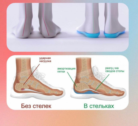 Коррекционные стельки