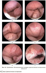 Гистероскопия. Диагностика и лечение внутриматочных заболеваний - Фото 8