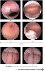 Гистероскопия. Диагностика и лечение внутриматочных заболеваний - Фото 9