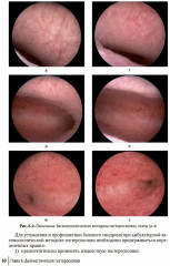 Гистероскопия. Диагностика и лечение внутриматочных заболеваний - Фото 10