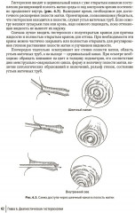 Гистероскопия. Диагностика и лечение внутриматочных заболеваний - Фото 12