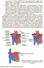 Врожденные пороки сердца у детей - Фото 4