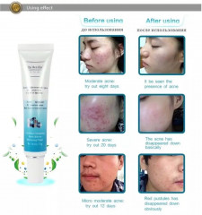 Крем для лица против прыщей и угрей - Фото 3