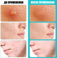 Цветные патчи-звездочки от акне и прыщей - Фото 3