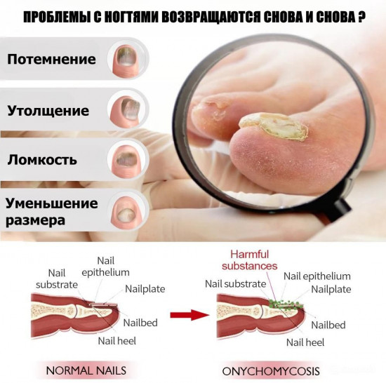 Жидкость для лечения грибка ногтей и восстановления ногтевой пластины