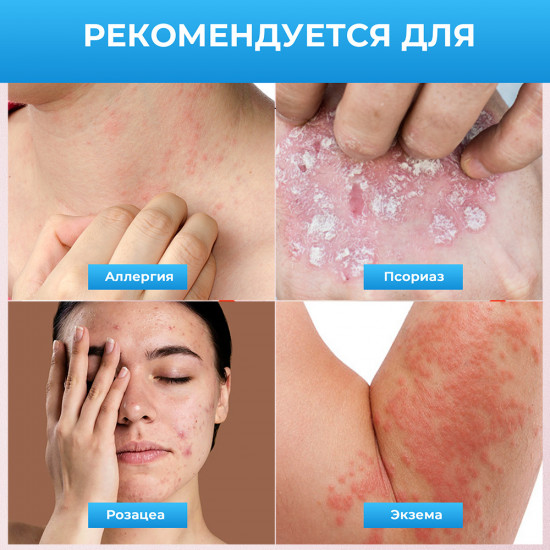 Увлажняющий противозудный крем от псориаза и экземы