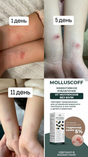 Лосьон для устранения вирусного моллюска «МоллюскОФФ»
