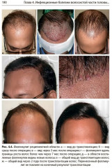Состояние волос при инфекционных заболеваниях. Диагностика, лечение и профилактика - Фото 15