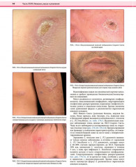 Дерматология по Фицпатрику. Том 4 - Фото 13