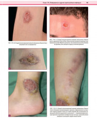 Дерматология по Фицпатрику. Том 4 - Фото 14