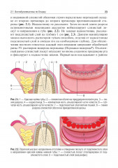 Вестибулопластика - Фото 7