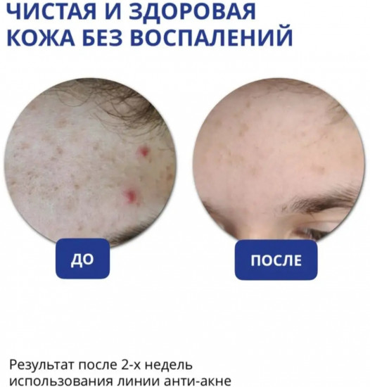 Успокаивающая анти-акне маска для лица
