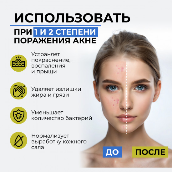 Мыло от угрей, черных точек с бензоил пероксидом «Perolite»