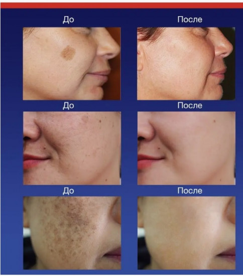 Отбеливающий крем для лица «Expigment 4%»