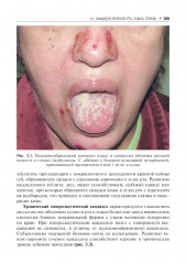 Микозы кожи и ногтей - Фото 7