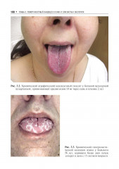 Микозы кожи и ногтей - Фото 8