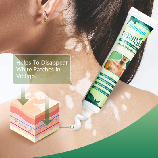 Мазь для лечения витилиго, белых пятен и пигментных нарушений «Vitiligo Treatment Ointment»