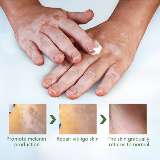Мазь для лечения витилиго, белых пятен и пигментных нарушений «Vitiligo Treatment Ointment»