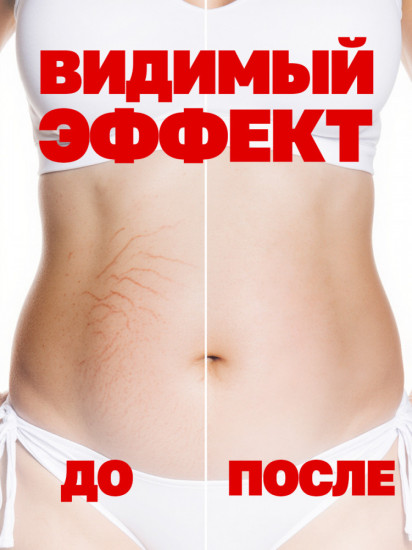 Крем от растяжек, рубцов и шрамов роликовый