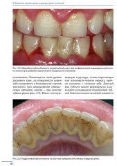 Профессиональная и индивидуальная гигиена полости рта у взрослых - Фото 4