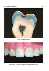 Оперативная дентистрия - Фото 11