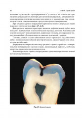 Оперативная дентистрия - Фото 12