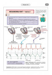 Имплантируемые кардиовертеры-дефибрилляторы. Иллюстрированное пошаговое руководство - Фото 13